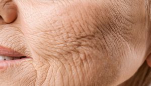 Treatments to reduce wrinkles