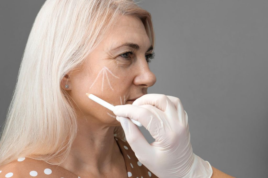 deep plane facelift