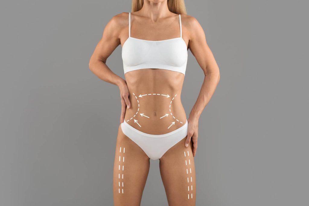 Renuvion J-Plasma vs. traditional skin tightening