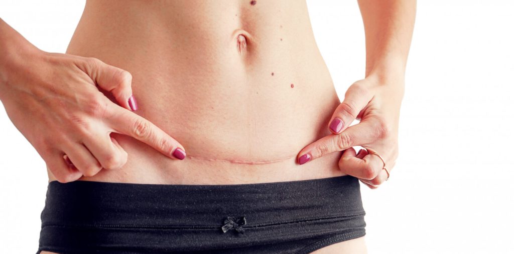 Plastic Surgery Scars