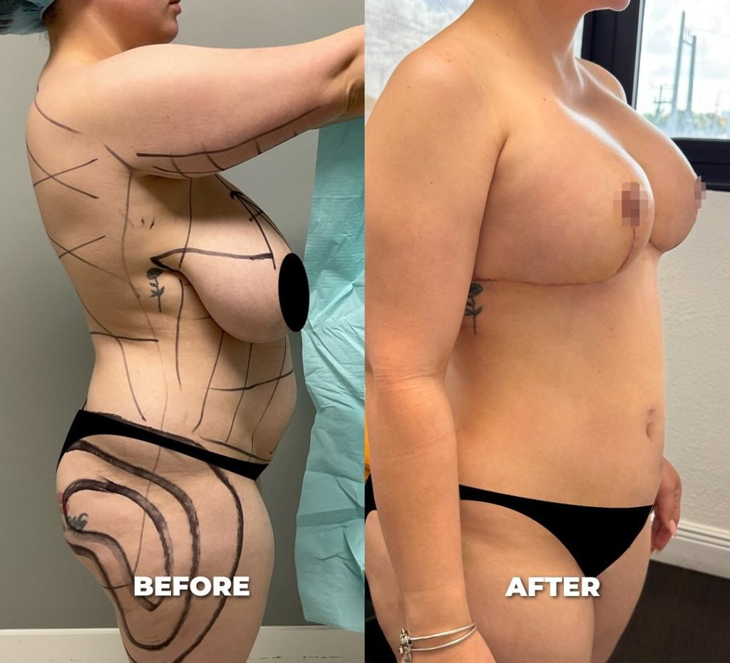 before and after mommy makeover recovery