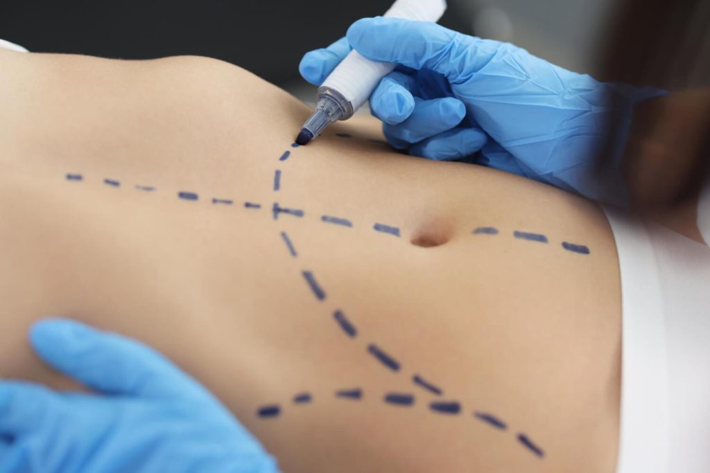 Stomach Liposuction