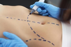 Stomach Liposuction