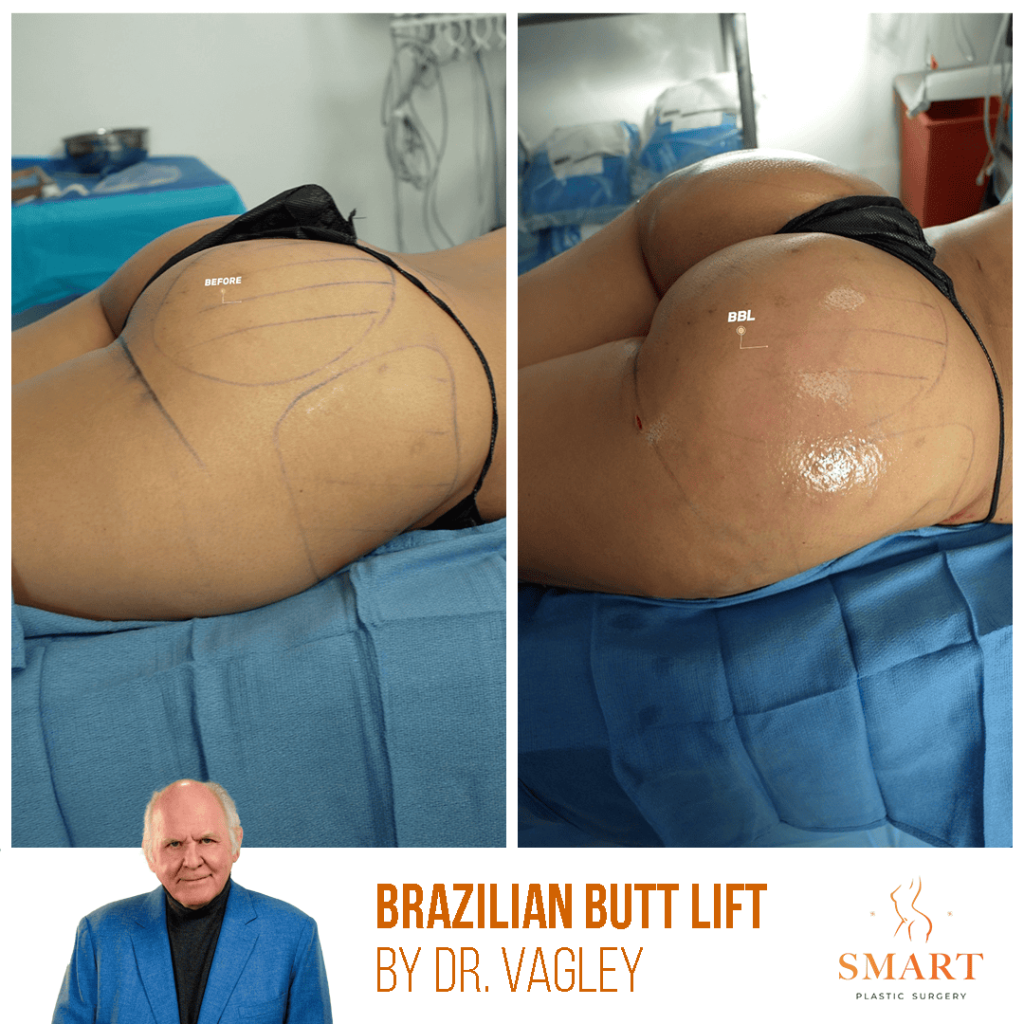 Brazilian Butt Lift