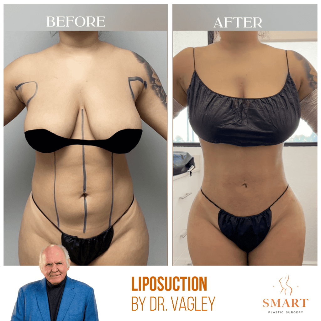 Liposuction