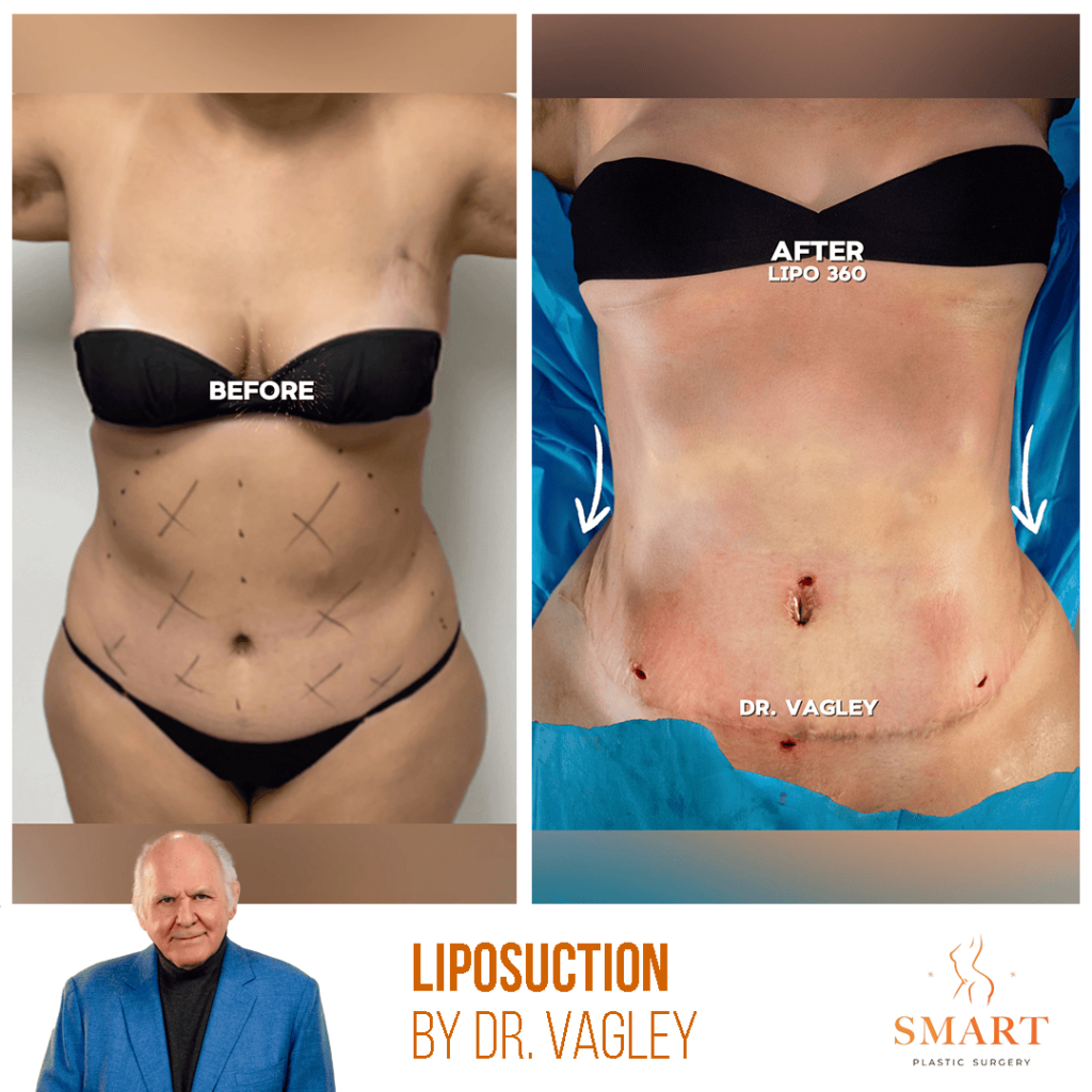 Liposuction