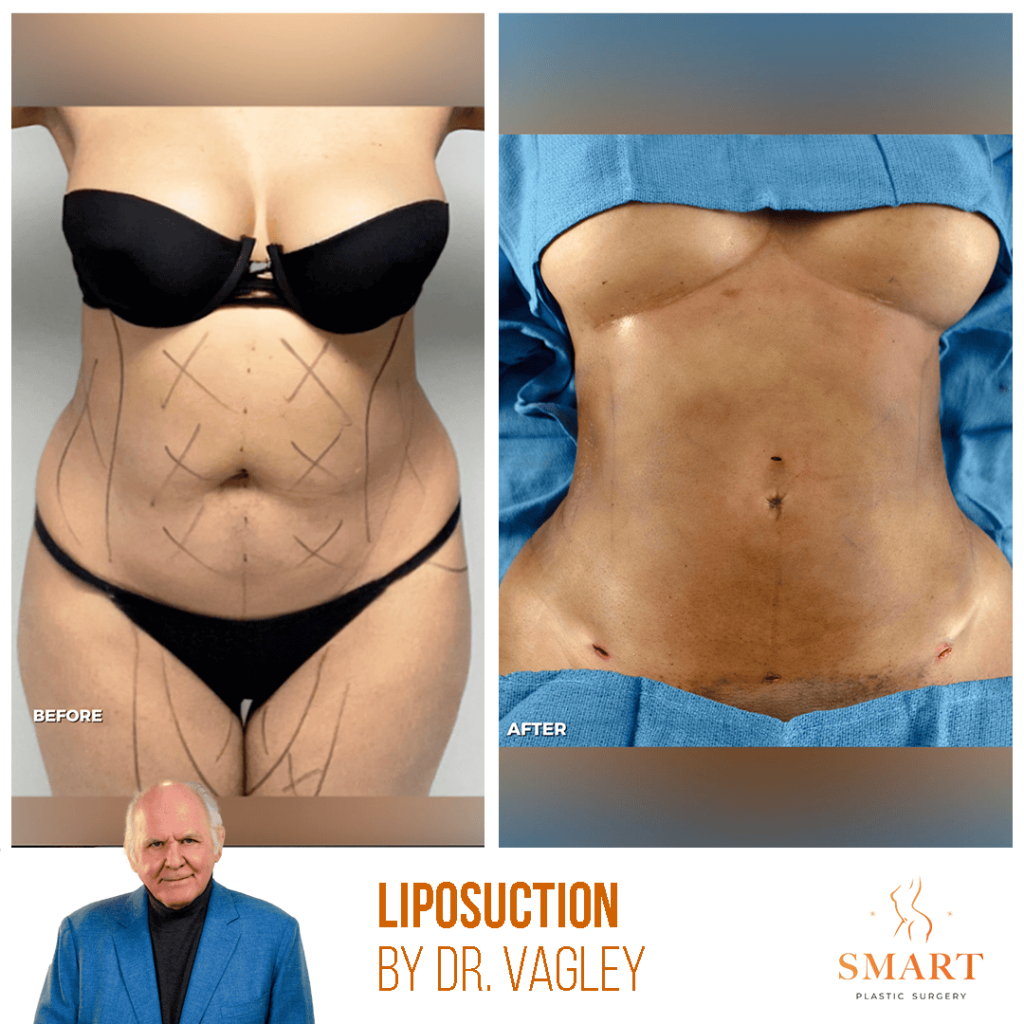 Liposuction