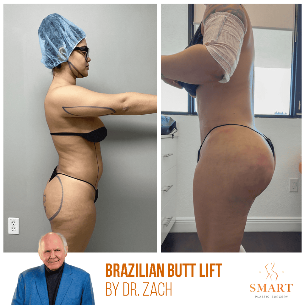 Brazilian Butt Lift