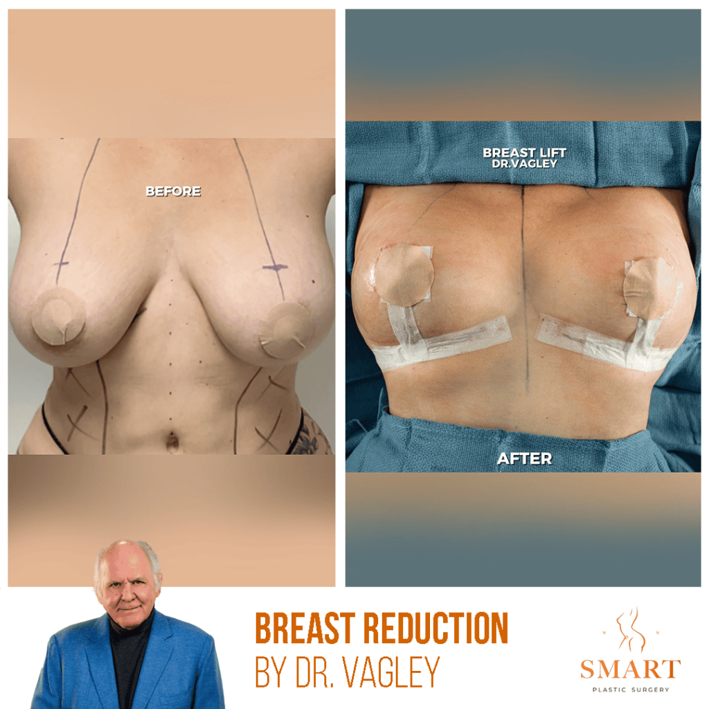 Breast Reduction