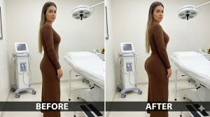 Brazilian Butt Lift Before and After