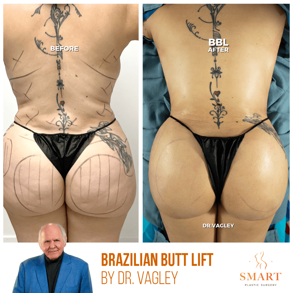 Brazilian Butt Lift
