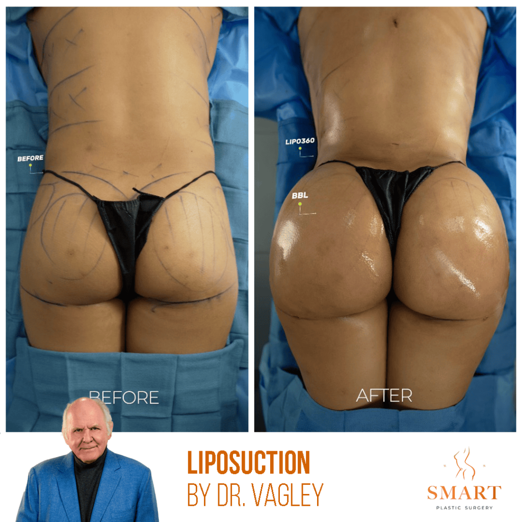 Liposuction