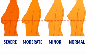 breasts sag after weight loss