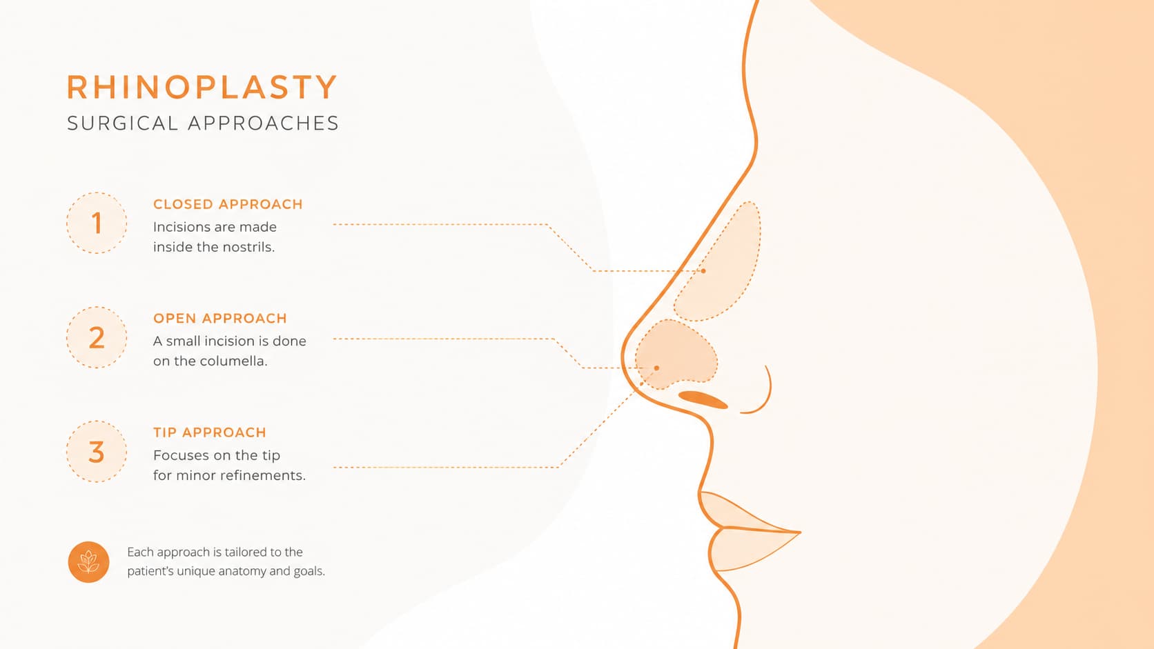 illustration showing a side profile of a nose with dotted guide lines highlighting different surgical approach zones, explaining the main types of rhinoplasty