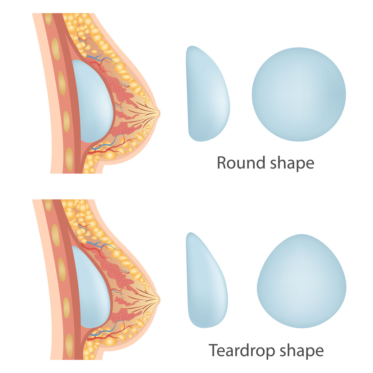 shapes implatns illustration