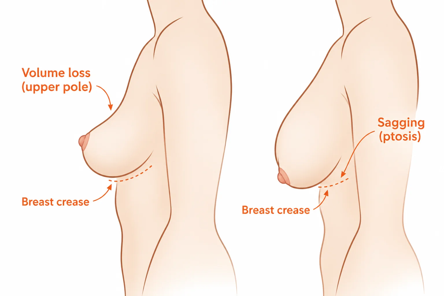 Illustration comparing deflated breasts with upper pole volume loss and sagging breasts with the nipple below the breast crease