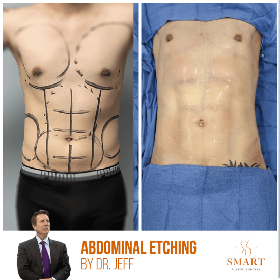 Lipo-360-1