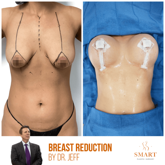 breast-3-1