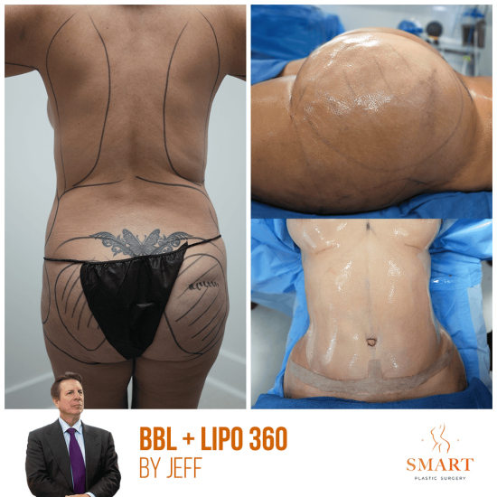 breast-augmentation-1