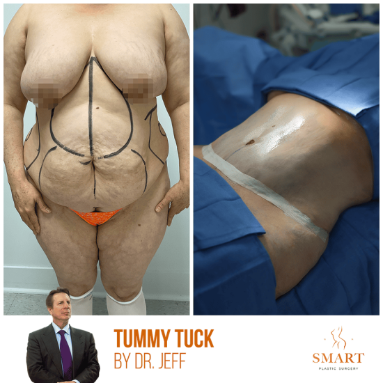 breast-augmentation-2-1