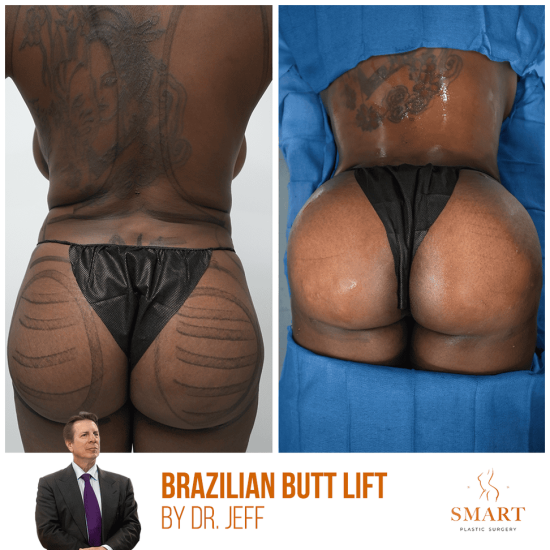 breast-lift_-1