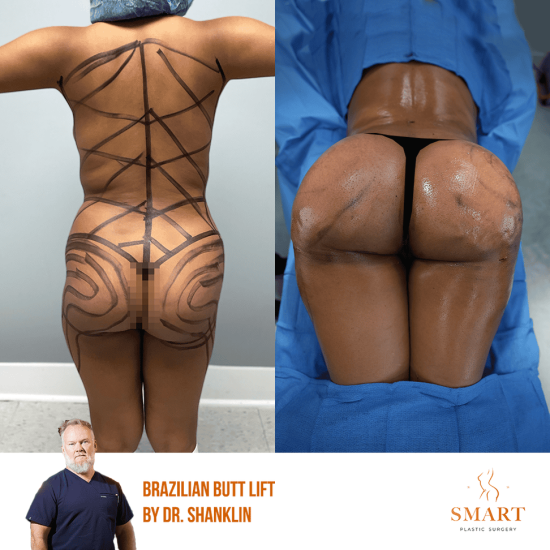 breast-lift_