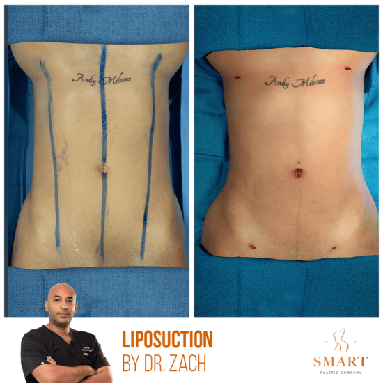 lipo-1