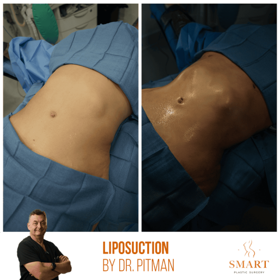 lipo