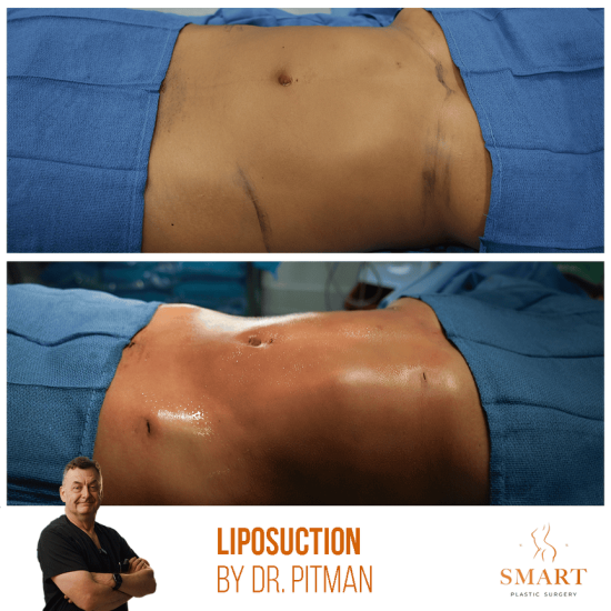 lipo1