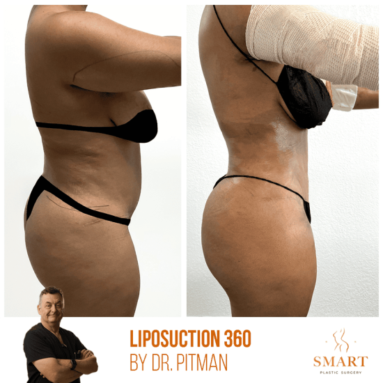 lipo2
