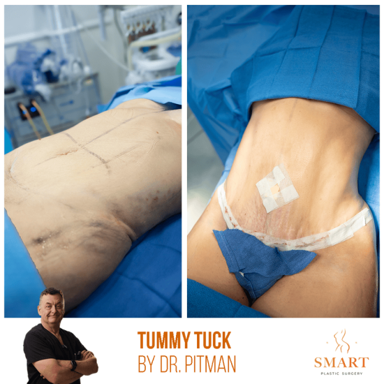 lipo4