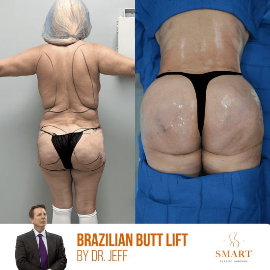 liposuction-1