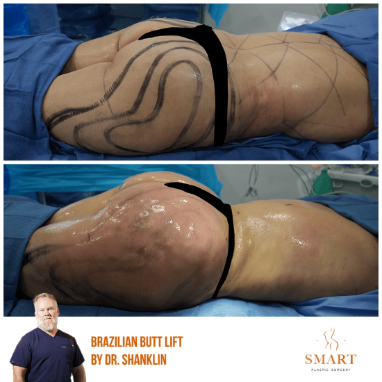 liposuction