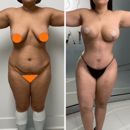 tummy-tuckbreast-augmentation